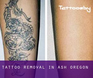 Tattoo Removal in Ash (Oregon)