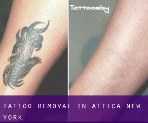 Tattoo Removal in Attica (New York)