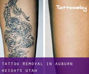 Tattoo Removal in Auburn Heights (Utah)