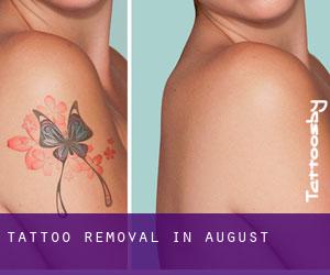 Tattoo Removal in August