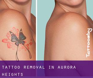 Tattoo Removal in Aurora Heights
