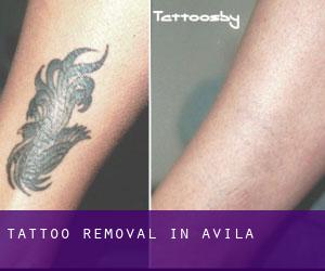 Tattoo Removal in Avila