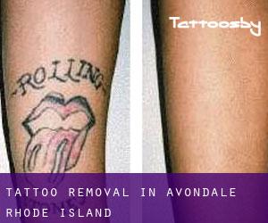 Tattoo Removal in Avondale (Rhode Island)