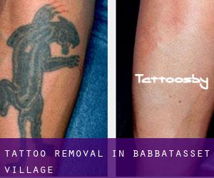Tattoo Removal in Babbatasset Village