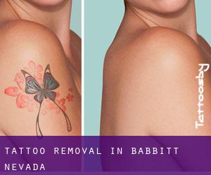 Tattoo Removal in Babbitt (Nevada)