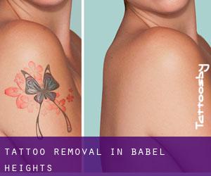 Tattoo Removal in Babel Heights