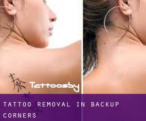 Tattoo Removal in Backup Corners