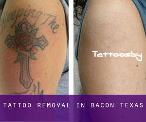 Tattoo Removal in Bacon (Texas)