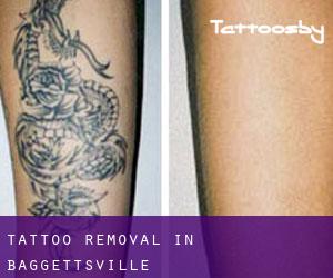 Tattoo Removal in Baggettsville