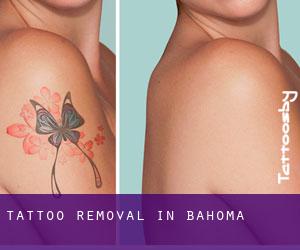 Tattoo Removal in Bahoma