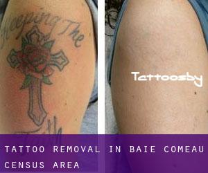 Tattoo Removal in Baie-Comeau (census area)