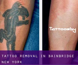 Tattoo Removal in Bainbridge (New York)