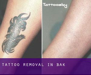 Tattoo Removal in Bak