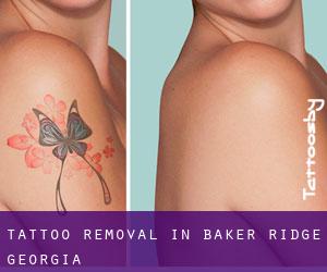 Tattoo Removal in Baker Ridge (Georgia)