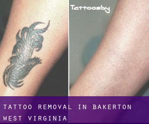 Tattoo Removal in Bakerton (West Virginia)
