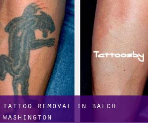 Tattoo Removal in Balch (Washington)