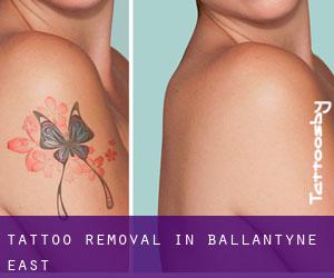 Tattoo Removal in Ballantyne East