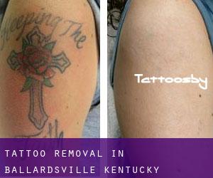 Tattoo Removal in Ballardsville (Kentucky)
