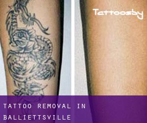 Tattoo Removal in Balliettsville