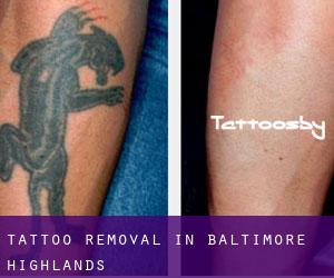 Tattoo Removal in Baltimore Highlands