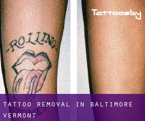 Tattoo Removal in Baltimore (Vermont)
