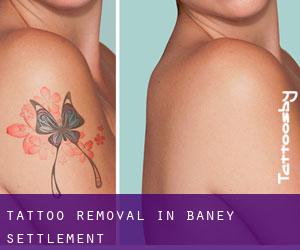 Tattoo Removal in Baney Settlement