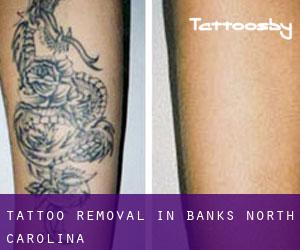 Tattoo Removal in Banks (North Carolina)