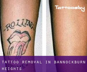 Tattoo Removal in Bannockburn Heights