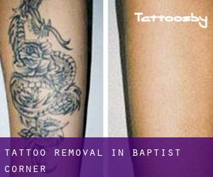 Tattoo Removal in Baptist Corner