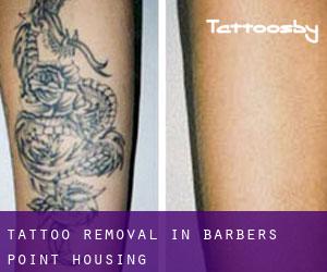 Tattoo Removal in Barbers Point Housing