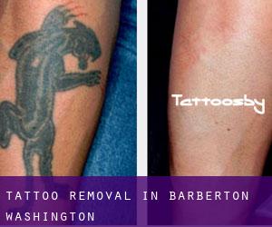 Tattoo Removal in Barberton (Washington)
