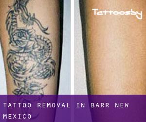 Tattoo Removal in Barr (New Mexico)