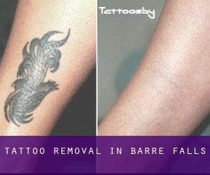 Tattoo Removal in Barre Falls