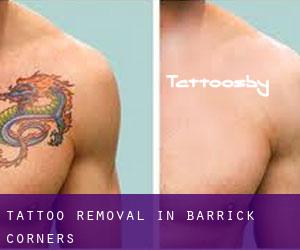 Tattoo Removal in Barrick Corners