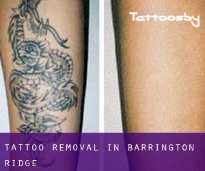 Tattoo Removal in Barrington Ridge