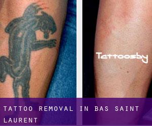 Tattoo Removal in Bas-Saint-Laurent
