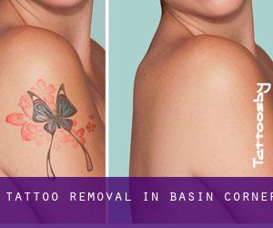 Tattoo Removal in Basin Corner