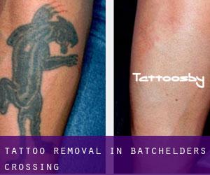 Tattoo Removal in Batchelders Crossing