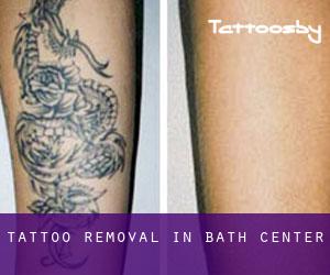 Tattoo Removal in Bath Center