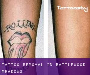 Tattoo Removal in Battlewood Meadows