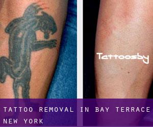 Tattoo Removal in Bay Terrace (New York)
