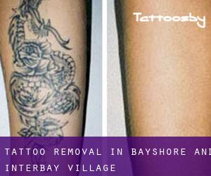 Tattoo Removal in Bayshore and Interbay Village