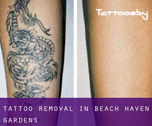 Tattoo Removal in Beach Haven Gardens