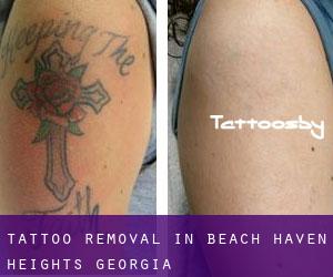 Tattoo Removal in Beach Haven Heights (Georgia)