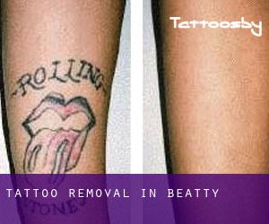 Tattoo Removal in Beatty