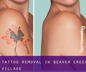 Tattoo Removal in Beaver Creek Village
