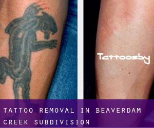Tattoo Removal in Beaverdam Creek Subdivision