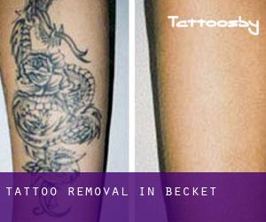 Tattoo Removal in Becket