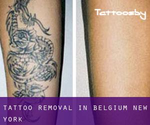 Tattoo Removal in Belgium (New York)
