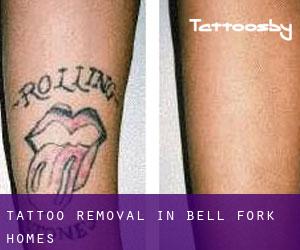 Tattoo Removal in Bell Fork Homes